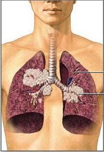医用黄色草莓视频免费在线观看肺癌与微量元素的密切关系