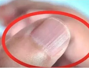 草莓视频IOS在线下载厂家分析手指甲有竖纹的根本原因